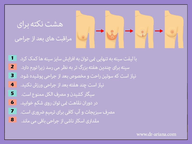 مراقبت های بعد از جراحی لیفت سینه