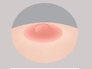 جراحی کوچک کردن نوک سینه