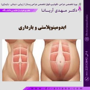 ابدومینوپلاستی و بارداری