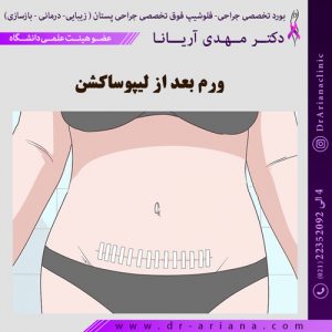 ورم بعد از لیپوساکشن