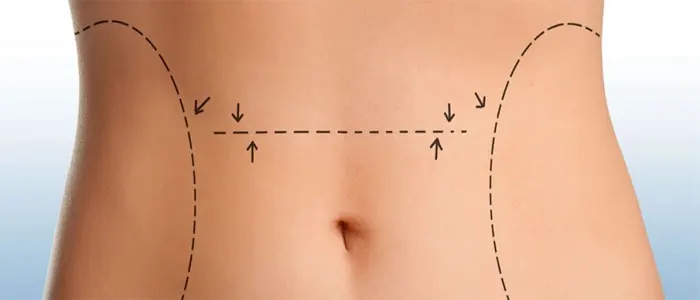 مراقبت در منزل بعد از جراحی شکم