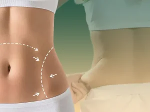 مراقبت های بعد از جراحی شکم