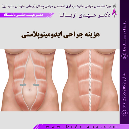 هزینه جراحی ابدومینوپلاستی