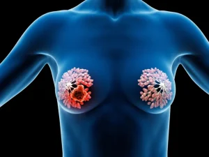 انواع جراحی های پستان