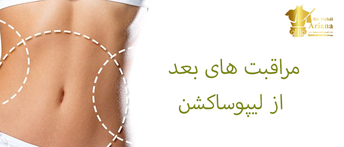 مراقبت های بعد از لیپوساکشن