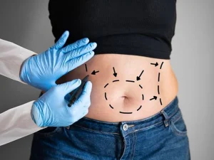 مراقبت‌های ضروری پس از لیپوساکشن