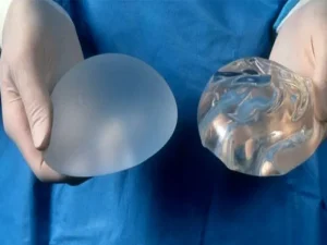 دوره نقاهت پروتز سینه