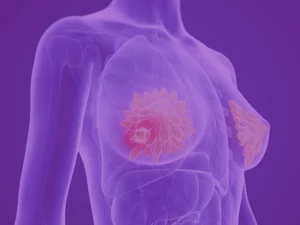 درمان سرطان سینه با جراحی