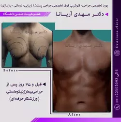 نمونه کار جراحی سینه در مردان