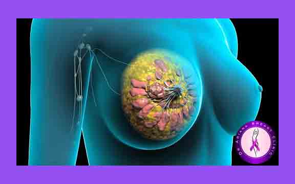 عوارض جراحی زیبایی سینه در شیردهی