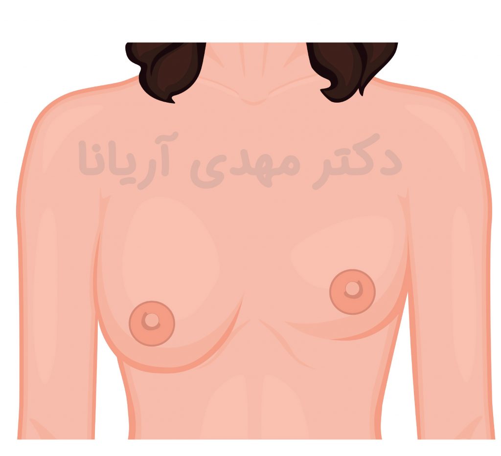 عدم تقارن در سینه ها