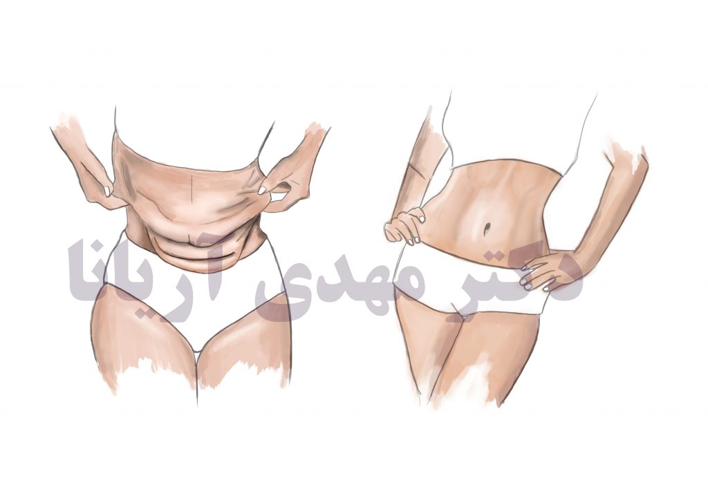 مراقبت بعد از ابدومینوپلاستی