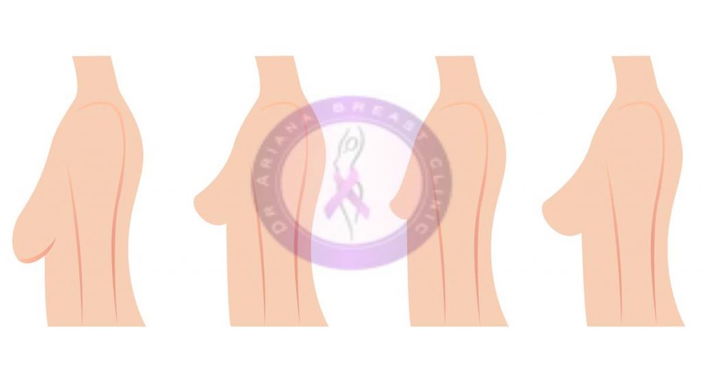 مراقبت بعد از لیفت سینه