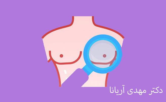 نقاهت پس از ژنیکوماستی