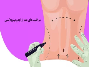 مراقبت های بعد از ابدومینوپلاستی