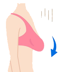 افتادگی سینه ها