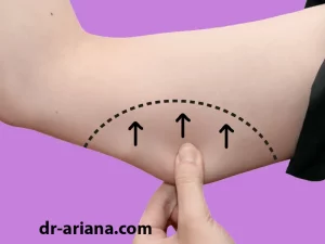 براکیوپلاستی