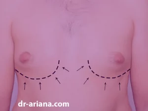 جای زخم و اسکار بعد از جراحی ژنیکوماستی