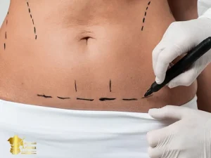 هزینه جراحی ابدومینوپلاستی