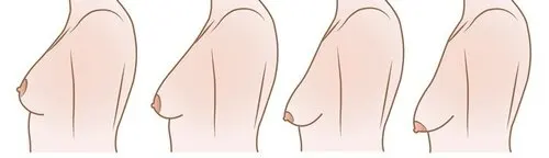 عکس لیفت سینه