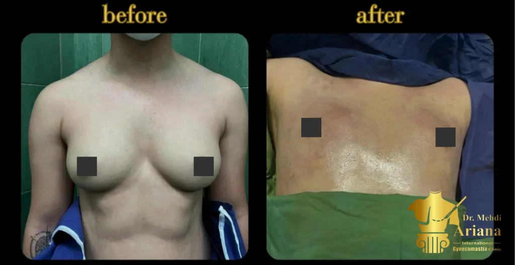 gynecomastia surgery result by Dr Ariana in Dubai