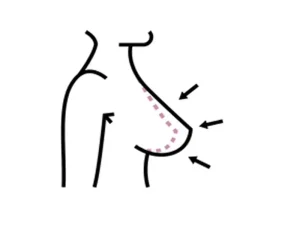 بهترین جراح لیفت سینه در تهران