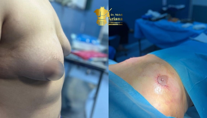 تخلیه پستان در افراد ترنس