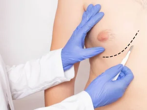 هزینه جراحی ژنیکوماستی