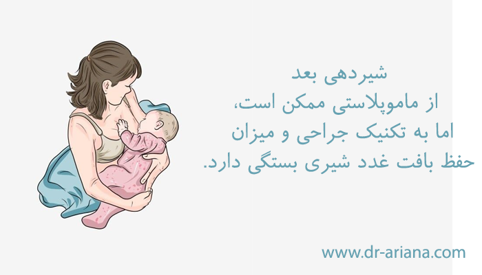شیردهی بعد از ماموپلاستی