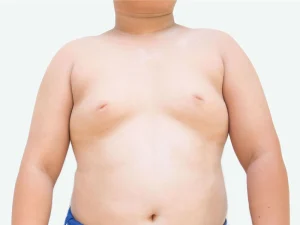 ژنیکوماستی در بلوغ و نوجوانان