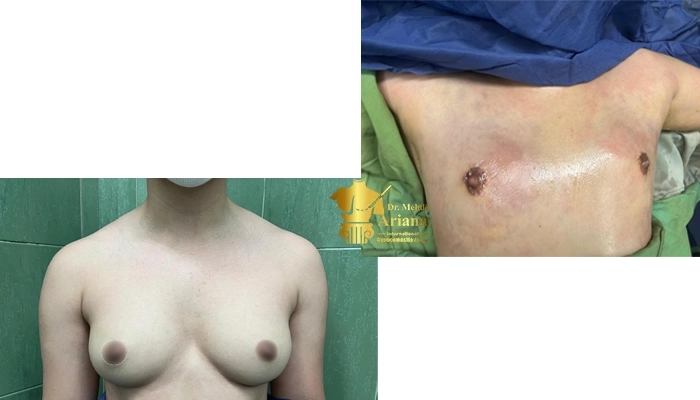 ژنیکوماستی دکتر آریانا