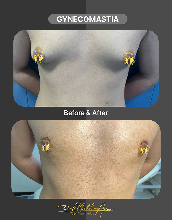 عمل ژنیکوماستی دکتر آریانا
