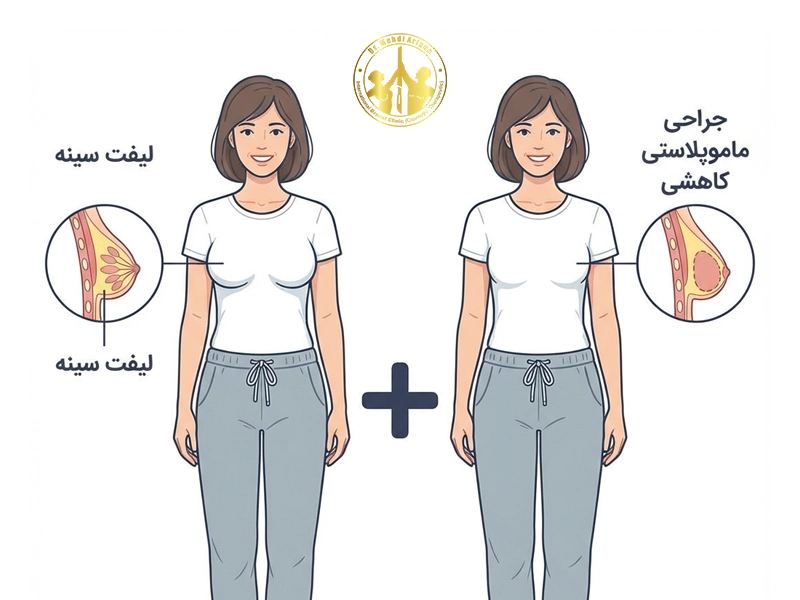 جراحی ماموپلاستی و لیفت همزمان
