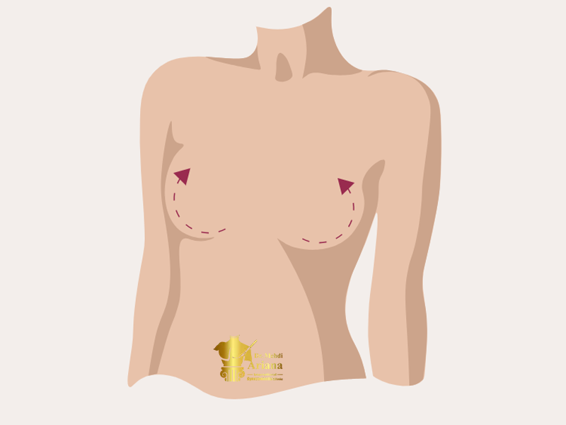 مزایای جراحی لیفت پستان بدون پروتز