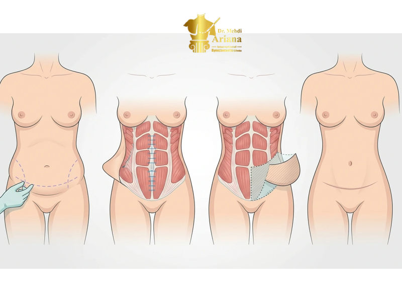 هزینه جراحی ابدومینوپلاستی